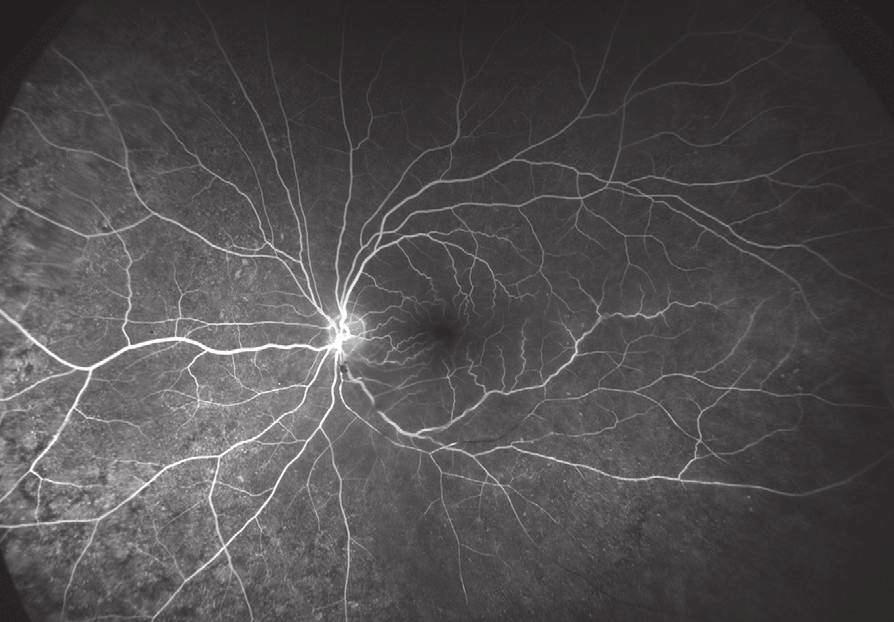 Retinal Artery Occlusion occurs when there is an obstruction to the blood flow in the arteries.