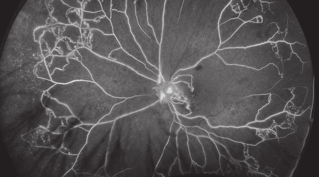 Ocular Ischemic Syndrome Retinal Vein Occlusion is a retinal vascular