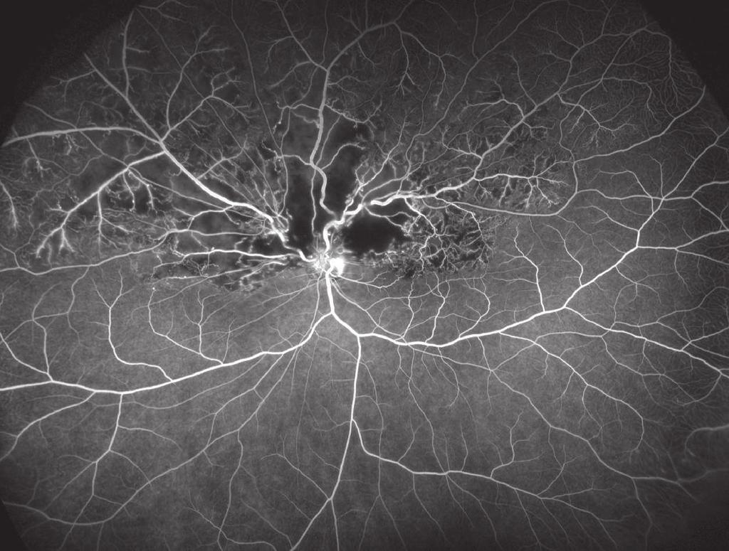 Delayed perfusion of the retina and choroidal circulation, macular edema
