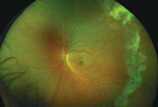 Sickle Cell Retinopathy Sickle Cell Retinopathy is a hereditary blood