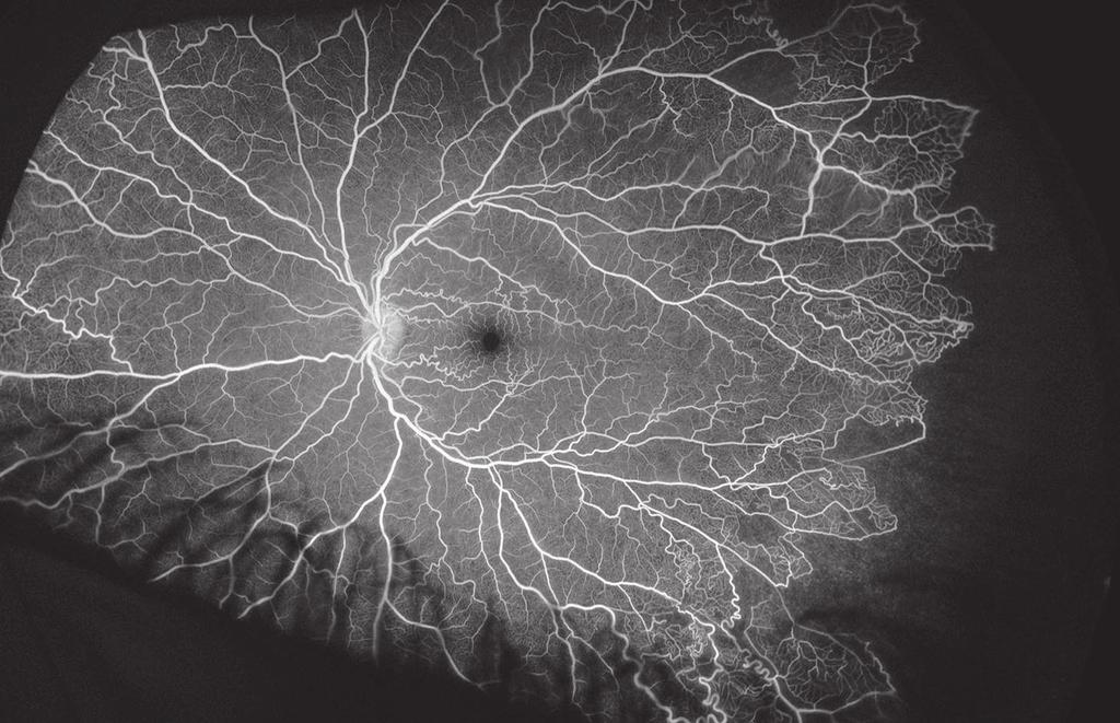proliferative retinopathy and has been correlated with macular vessel