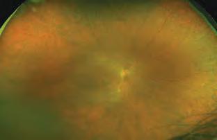 Choroidal Neovascular Membrane (CNV, CNVM) is associated with AMD and there are two types: classic and occult.