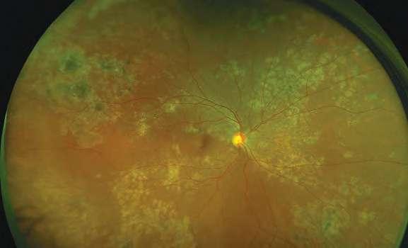 Uveitis Inflammatory Disease is inflammation of any of the structures of the