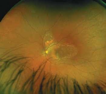 ROP Retinopathy of Prematurity (ROP) is a retinal vasculature disorder that affects severely premature babies, resulting from incomplete peripheral vascularization at birth followed by abnormal