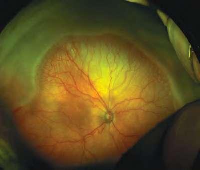 1,2 Best Disease is a juvenile disease and vitelliform macular degeneration is an inherited eye condition.