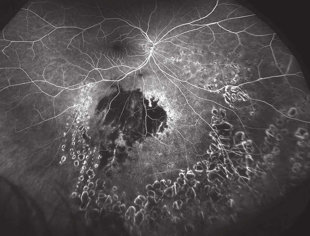 Choroidal Melanoma Tumors is a form of malignant tumor derived from pigment cells initiated in the choroid.