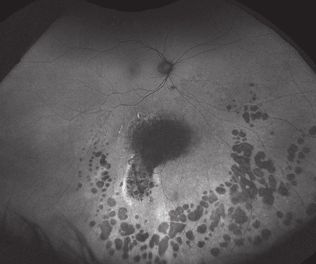 patterns of vascular damage that can be associated with choroidal tumors and their treatment. 1 26 1.
