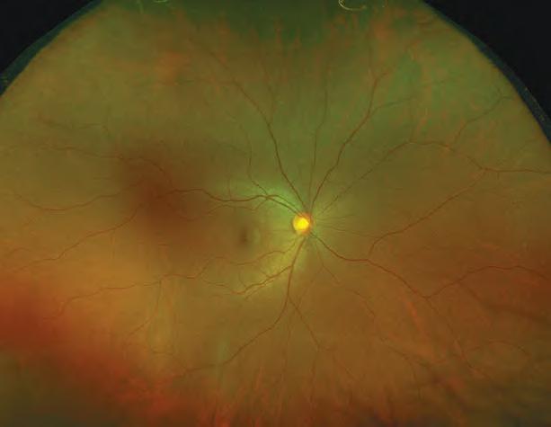 Fluorescein Angiography optomap color composite images provide a structural image of the retina.