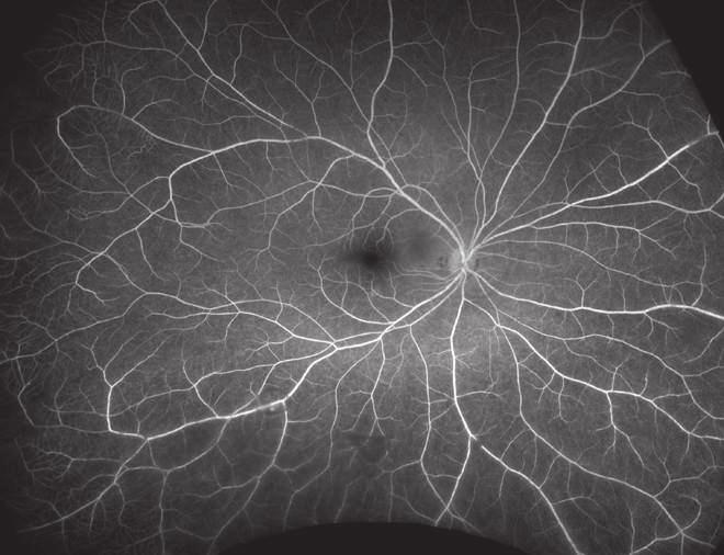 Fluorescein Angiography Phases Phase Choroidal Flush/ Pre-Arterial Phase Arterial Arterial-Venous Phase Venous Phase Recirculation Phase Timing 10-12 seconds choroid fills 1 second before the