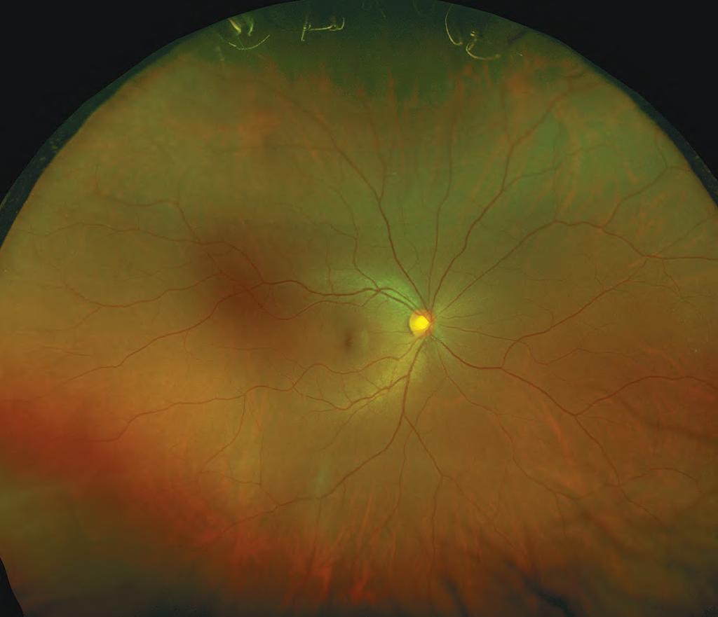 Retinal Anatomy The Retina is the light-sensitive layer of tissue that lines the inside of the eye and sends visual messages through the optic nerve to the brain.