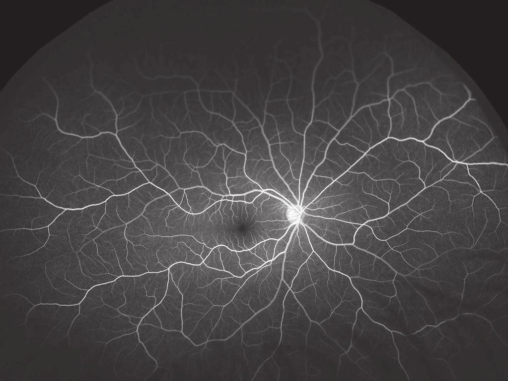 Fluorescein Angiogram of a Healthy Retina Arteriovenous Crossings are areas where the artery and vein meet within the retina these however can result in occlusions which can be observed on an FA.