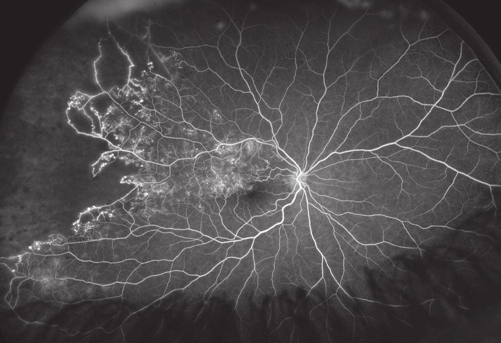 Retinal Vein Occlusion Filling defect from non-perfusion Hypofluorescence Blocking defect An absence or marked decrease of fluorescence observed in an area that would