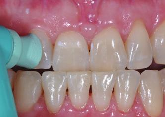 gingival margin (and CEJ) and make sure to cover all attached gingiva 4-5mm;