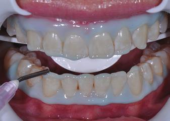 Teeth should fit directly into mouthpiece for best whitening results.