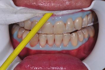 teeth; for to a total of four 8-minute best results, prior to reapplying