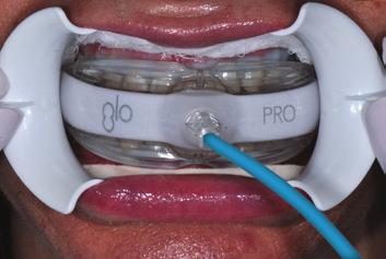 19 onfirm gingival barrier is still C intact; wipe mouthpiece of any residual