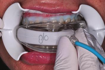 2 2 3 The GLO universal mouthpiece Pumice patient s teeth. is flexible.