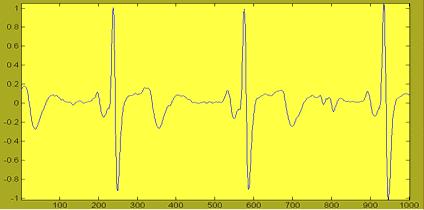 The power line interference is also removed by passing it through an 11 Hz band pass filter.