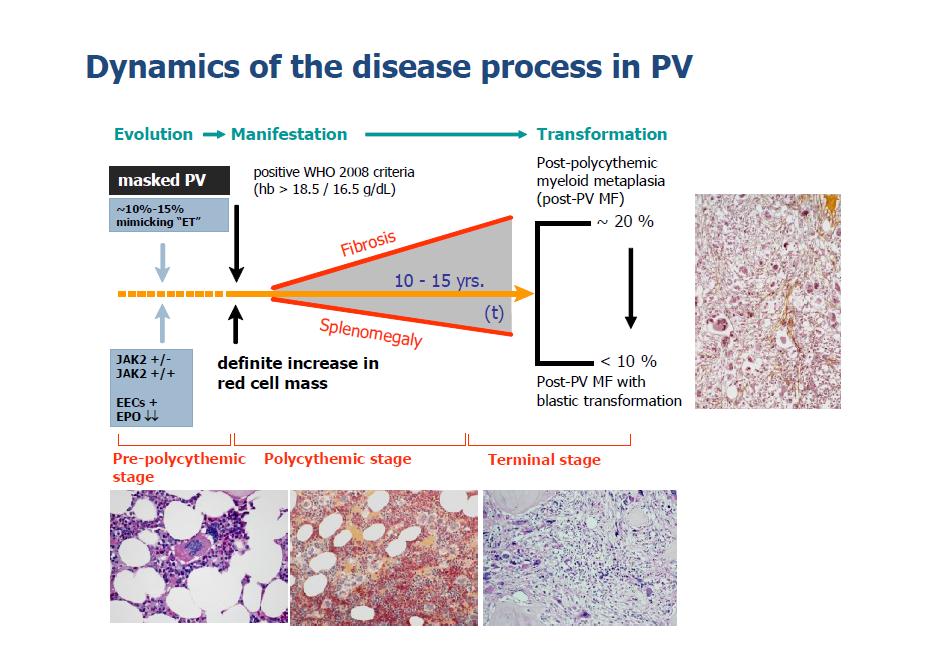 DIAGNOSIS Recognizing ET from Early-Phase PV in