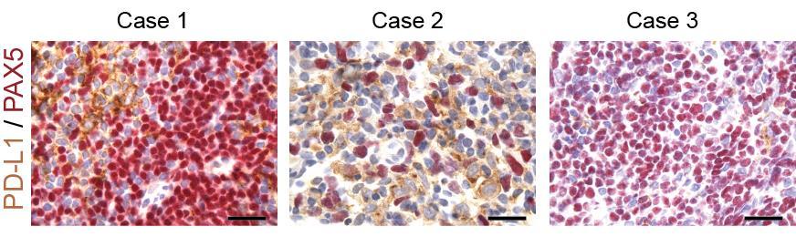 PD-L1 Expression in the Follicular Lymphoma Microenvironment PAX5+ (red)/ PD-L1- (brown) follicular lymphoma cells PAX5 -/ PD-L1+ (brown)