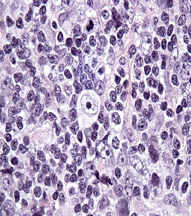Background Pathology of chl: rare malignant Reed-Sternberg cells within an extensive inflammatory/immune cell infiltrate. Genetic analyses: frequent 9p24.