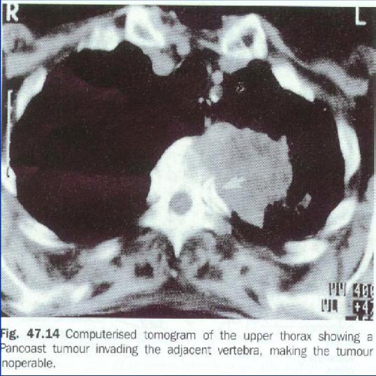 Computerised tomography (CT) Shows the tumor & its extensions,