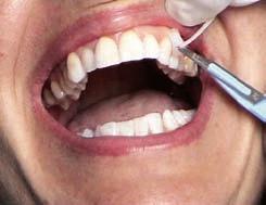 9 Remove the excess belt with a scalpel by cutting on the flat edge on the buccal surface of the anchorage