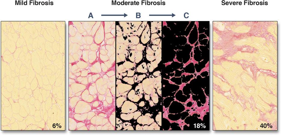 958 Figure 2. Histology of an Intra-Myocardial Biopsy Sample in 3 Patients With Severe Aortic Stenosis Picrosirius red stains collagen (fibrosis) red/pink, and counter stains myocytes yellow (A).