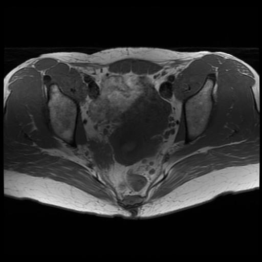 Sidewall Resection Peritoneum, Ureter Internal iliac vessels beyond superior gluteal branch Common iliac