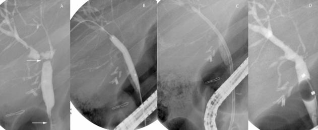 Endoscopic therapy (A) Dominant strictures (B) Balloon dilatation of the strictures.