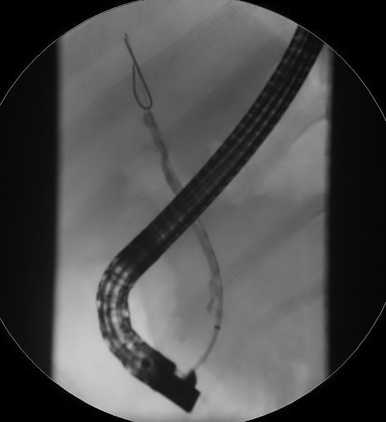 Diagnosis Combination of : Cholestatic biochemical profile multifocal strictures on cholangiography exclusion of secondary sclerosing cholangitis ERCP: Gold standard, but has
