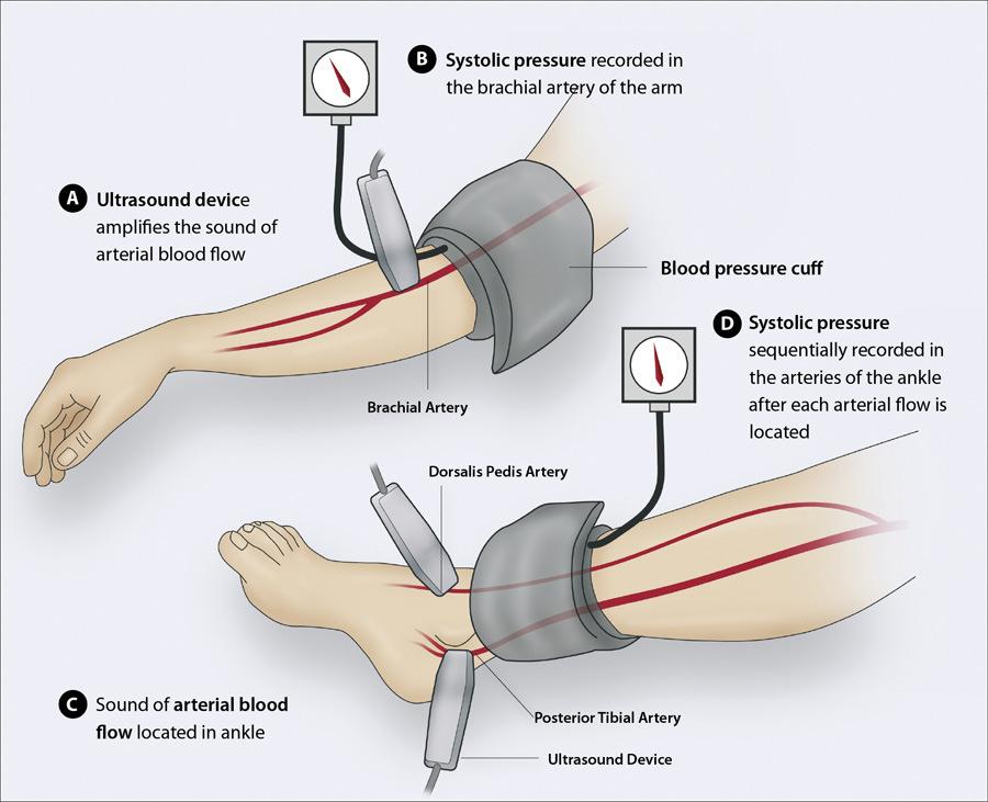 Step 7: If no signal can be found at either the PTA or DPA/ATA sites, locate the peroneal artery (PERA) usually found either: on the lower leg just above the lateral malleolus on the foot arch.