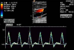 ultrasound can produce a map of significant stenotic disease from aorta to