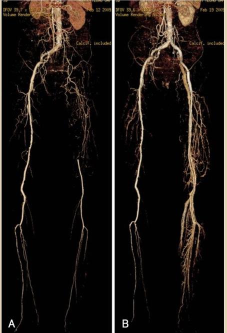 Computed tomographyangiography (CTA) of the lower extremity.