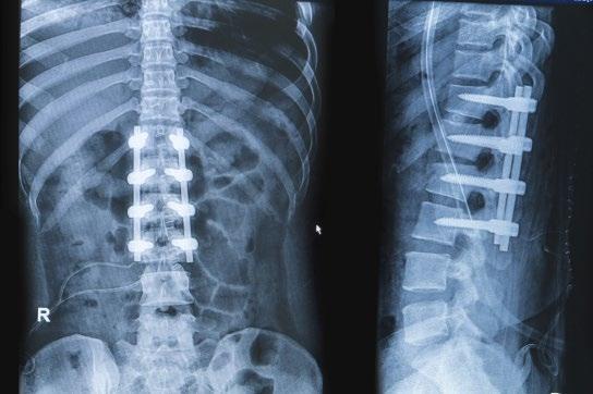Spinal Fusion Surgery Why do I need spinal fusion surgery?