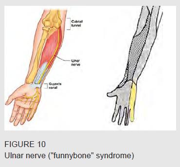 Tight fitting wetsuits or leaning on the elbow may compress the ulnar nerve in the region of the cubital tunnel (i.e., the funny bone) causing numbness of the lower palm of the hand.