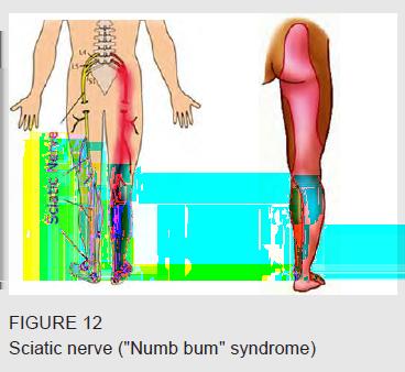 Pressure on the sciatic nerve due to sitting on a hard surface may cause