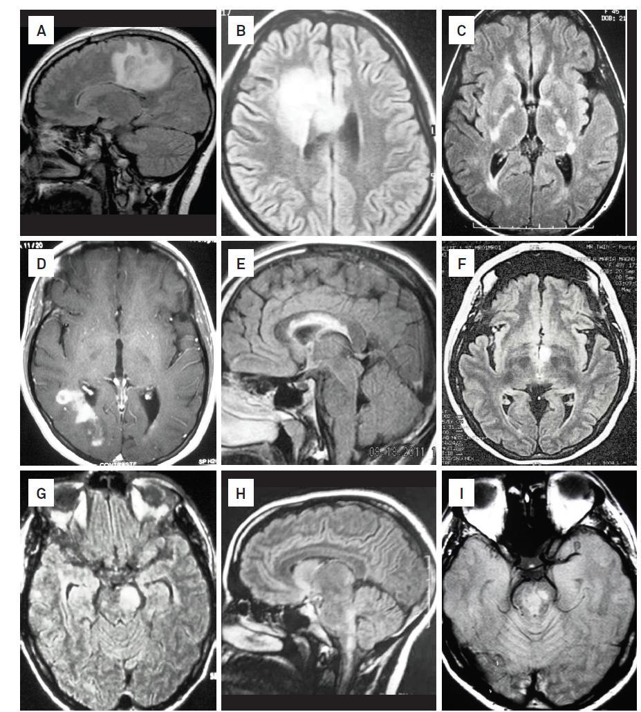 FIGURE 2: typical MRI features of NMO and spectrum disorders: Typical MRI sites of involvement in NMO and NMO spectrum disorders A MRI brain showing edematous periventricular lesion B Tumefactive