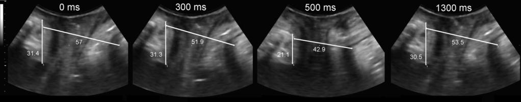 Pelvic floor reflexes Figure 2 Measurements of bladder neck descent and hiatal diameter during a cough cycle, recorded at 20 volumes/s.