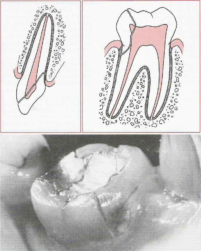 Soft Tissue and Dentoaiveolar Injuries CHAPTER 23 515 FIG. 23-9 Crown cracks or crazes. These usually extend only into enamel. FIG. 23-10 Coronal fractures involving enamel, dentin, and pulp. FIG. 23-11 Crown-root fractures.