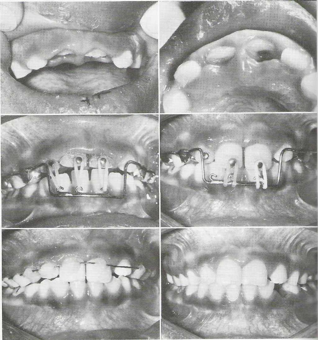 518 PART VI Oral and Maxillofaciai Trauma FIG. 23-15 Treatment of intruded maxillary incisors with immature apices. Buccai (A) and palatal (B) views of intruded maxillary incisor teeth.