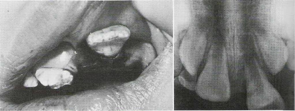 520 PART VI «Oral and Maxillofacial Trauma FIG. 23-17 Treatment of laterally displaced central incisor in apicaily immature tooth. A, Appearance on presentation. B, Radiograph showing position.