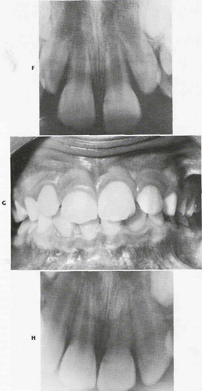 522 PART VI Oral and Maxillofacial Trauma F1G. 23-17 cont'd F, Radiograph of tooth after removal of stabilizing appliance. G, Appearance of tooth 1 year after trauma.