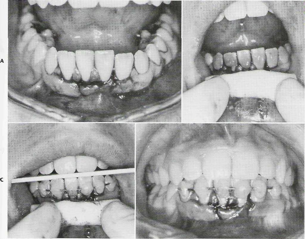 Soft Tissue and Dentoalveolar Injuries CHAPTER 23 523 FIG. 23-18 Technique of acid-etch composite stabilization of displaced teeth. A, Lower incisor teeth displaced lingually.