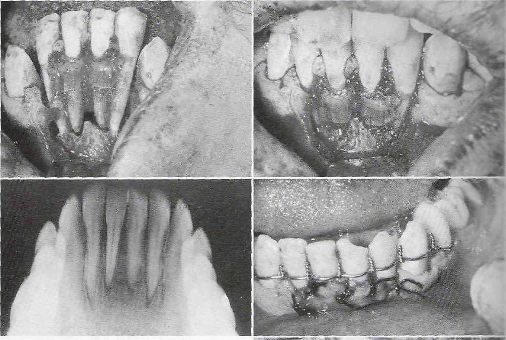 524 PART VI Oral and Maxillofadal Trauma FIG. 23-19 Treatment of dentoalveolar fracture. A, Clinical appearance of fracture involving four mandibular incisors.