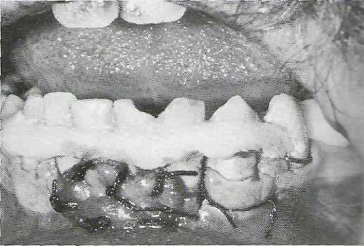Occlusal relationship is verified before stabilization of these teeth. C, Radiographic appearance of teeth after digital reduction.