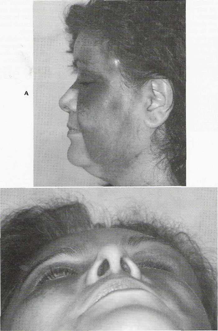 506 PART VI Oral and Maxillofacial Trauma FIG. 23-2 A and B, Soft tissue contusions with no underlying facial fractures caused by blunt injuries.