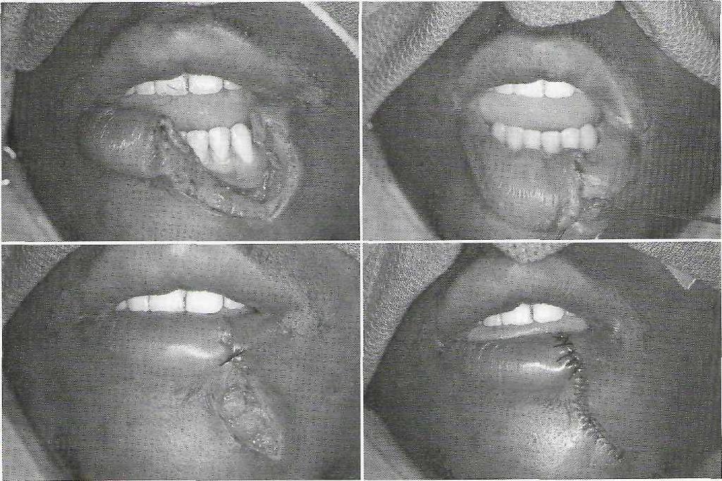 Soft Tissue and Dentoalveolar Injuries CHAPTER 23 507 FIG. 23-3 The repair of a full-thickness laceration of the lower lip. A, Tissues have been cleaned and hemostasis obtained.