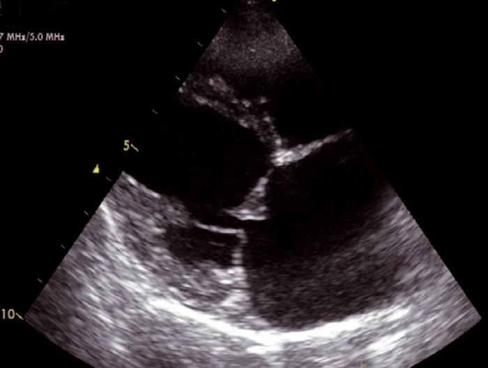 Figure 4. Right parasternal long axis view from an eight-yearold CKCS with DMVD.