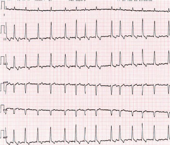 Figure 5. A six-lead ECG of a seven-year-old dog with a heart rate more than 210 bpm.